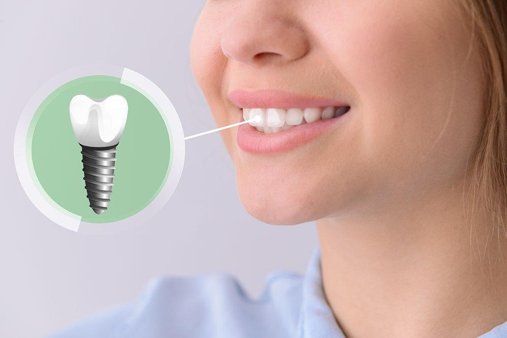 Mejora tu calidad de vida con un implante dental