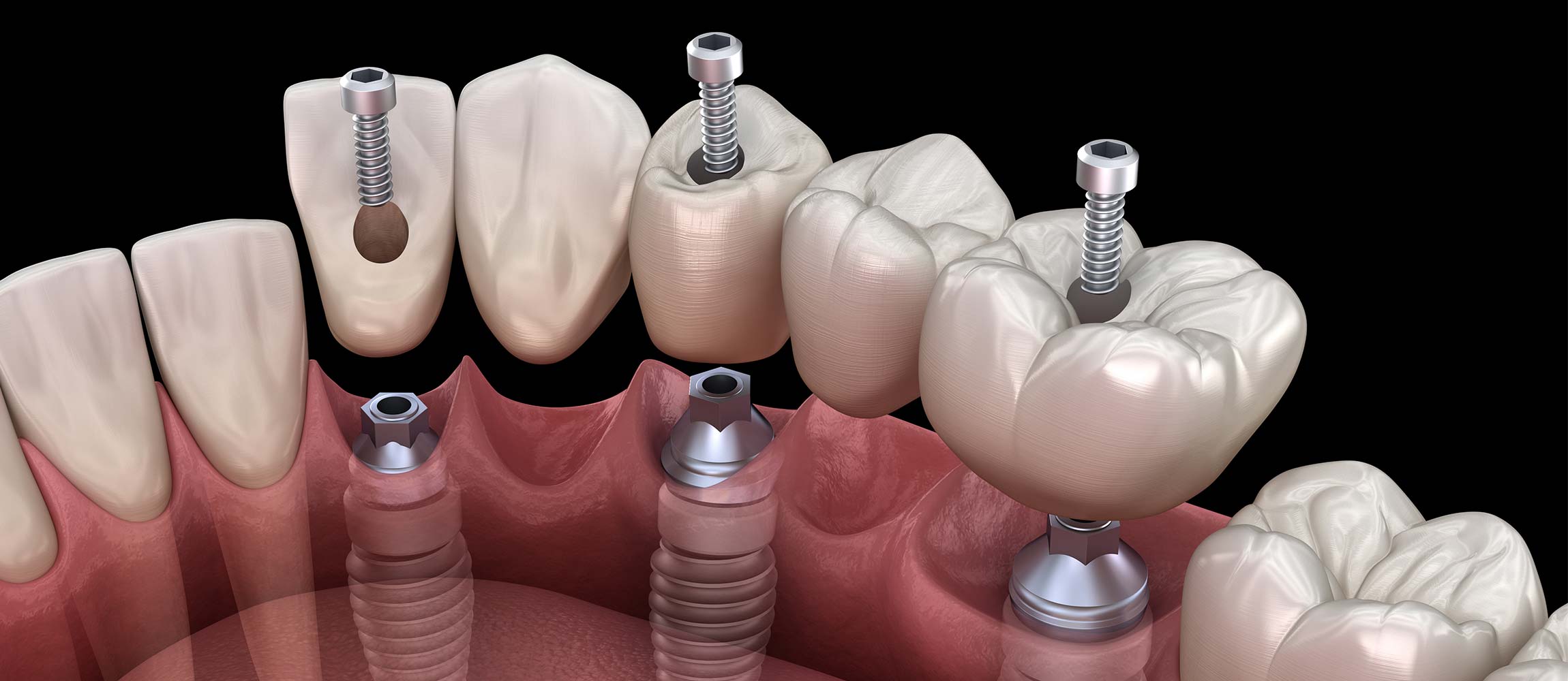 Mockup 3D de implantes dentales puente