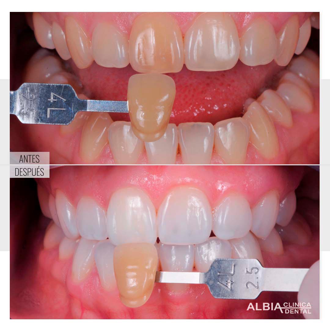 Imagen de paciente caso real de blanqueamiento dental