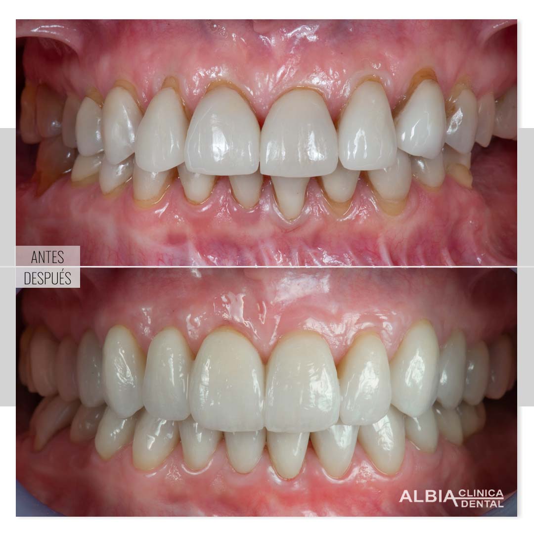 Imagen de antes y después de colocación de carillas dentales