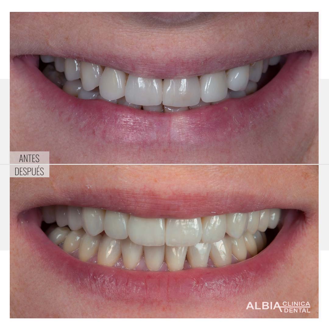 Antes y después de colocación de carillas dentales