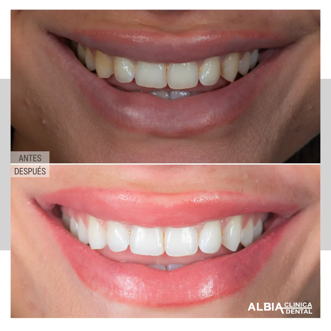 Caso de blanqueamiento dental