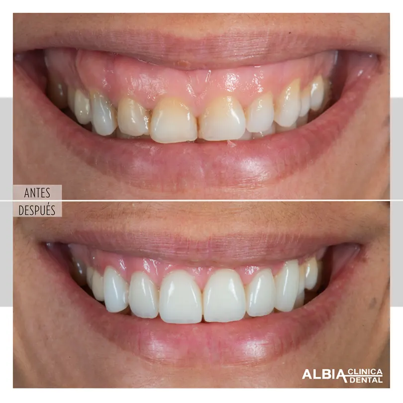 Caso de sonrisa gingival