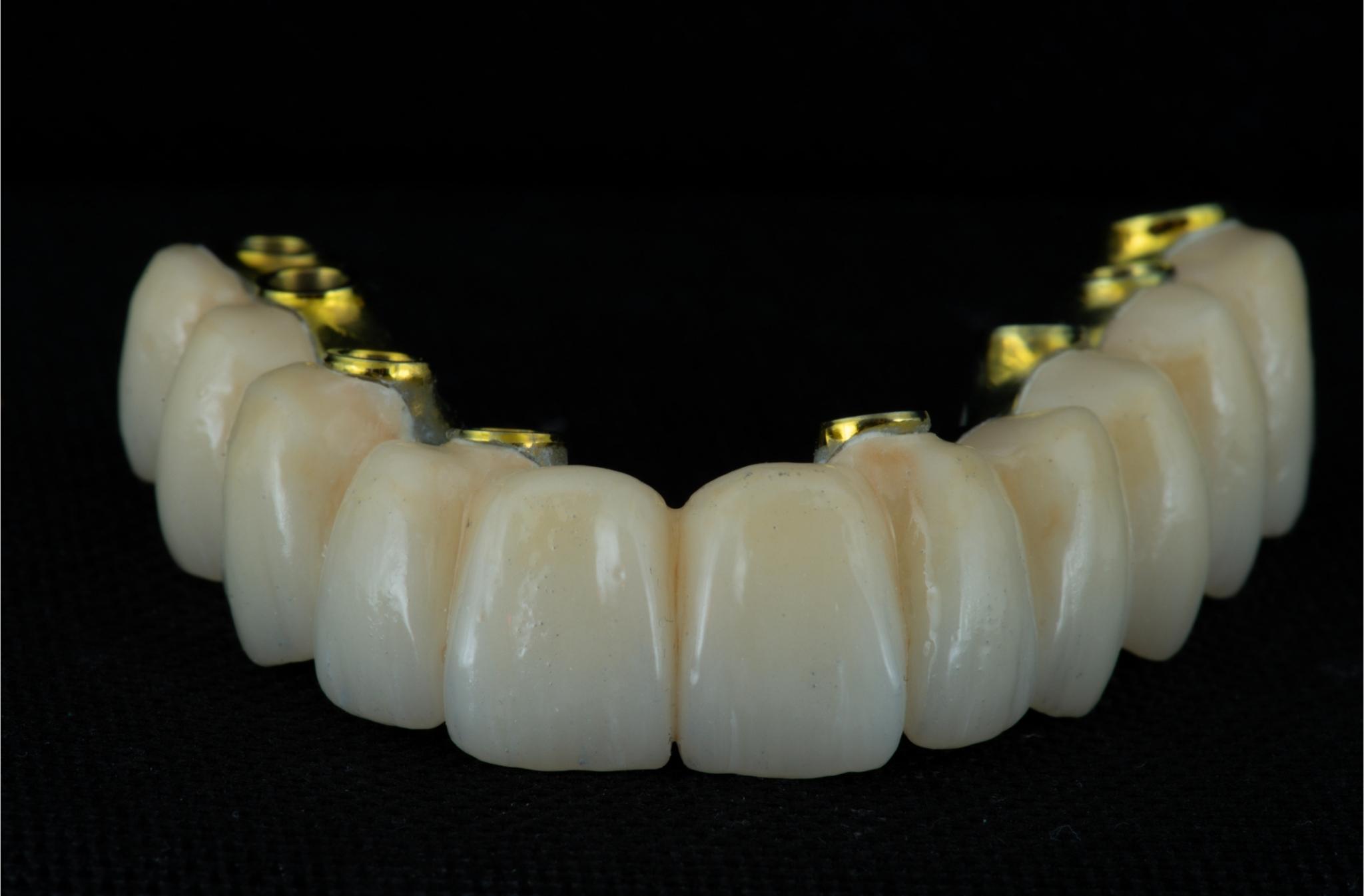 Prótesis de 8 implantes dentales fijos